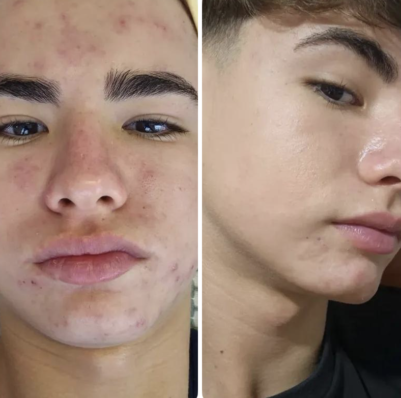 Antes e depois — tratamento de acne facial