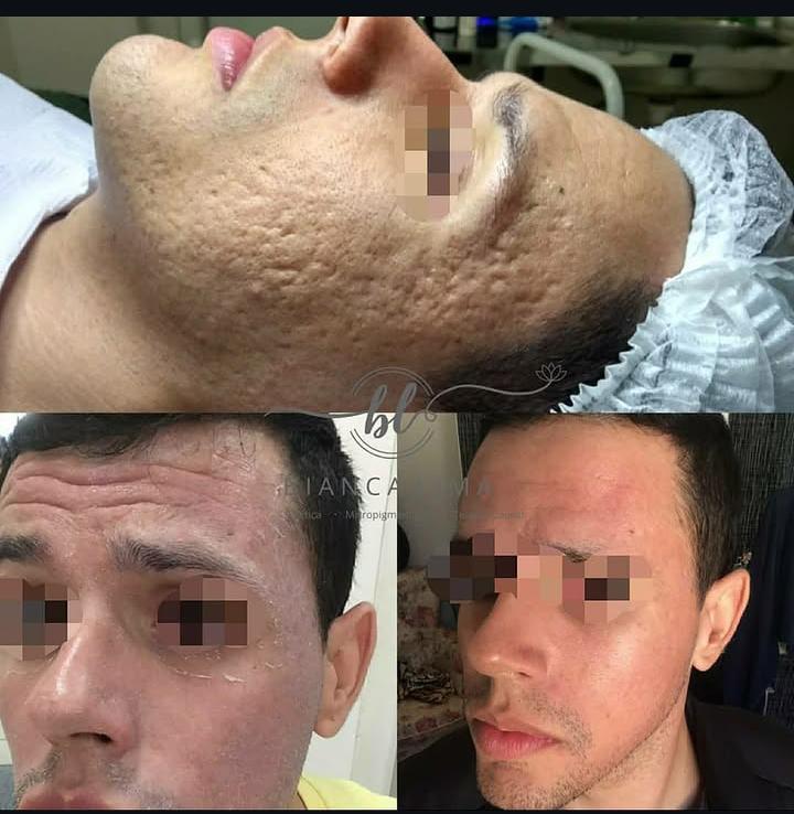 Antes e depois — microagulhamento para cicatrizes profundas