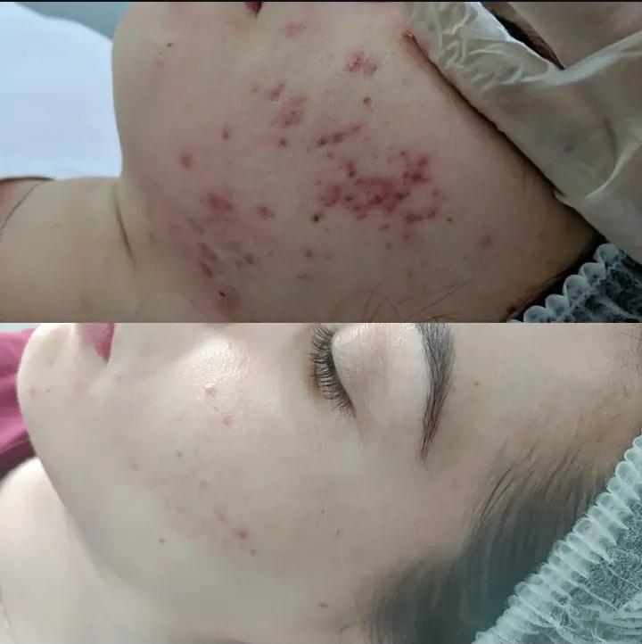 Antes e depois — clareamento de manchas e cicatrizes